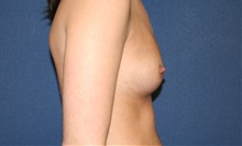Breast Augmentation Before Photo by Laurence Glickman, MD, MSc, FRCS(c),  FACS; Garden City, NY - Case 36329