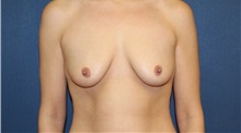 Breast Augmentation Before Photo by Laurence Glickman, MD, MSc, FRCS(c),  FACS; Garden City, NY - Case 36330