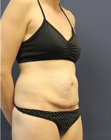 Tummy Tuck Before Photo by Laurence Glickman, MD, MSc, FRCS(c),  FACS; Garden City, NY - Case 36332