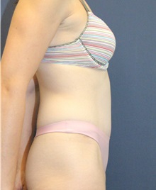 Tummy Tuck After Photo by Laurence Glickman, MD, MSc, FRCS(c),  FACS; Garden City, NY - Case 36332