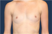 Breast Augmentation Before Photo by Laurence Glickman, MD, MSc, FRCS(c),  FACS; Garden City, NY - Case 36333