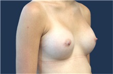Breast Augmentation After Photo by Laurence Glickman, MD, MSc, FRCS(c),  FACS; Garden City, NY - Case 36333