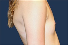 Breast Augmentation Before Photo by Laurence Glickman, MD, MSc, FRCS(c),  FACS; Garden City, NY - Case 36333