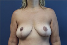 Breast Lift After Photo by Laurence Glickman, MD, MSc, FRCS(c),  FACS; Garden City, NY - Case 36334