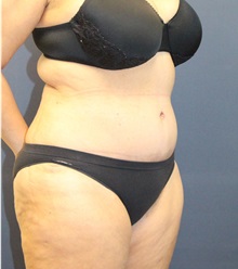 Tummy Tuck After Photo by Laurence Glickman, MD, MSc, FRCS(c),  FACS; Garden City, NY - Case 36336
