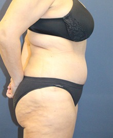 Tummy Tuck After Photo by Laurence Glickman, MD, MSc, FRCS(c),  FACS; Garden City, NY - Case 36336