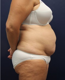Tummy Tuck Before Photo by Laurence Glickman, MD, MSc, FRCS(c),  FACS; Garden City, NY - Case 36336