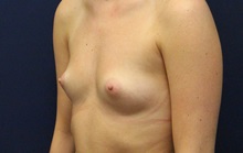 Breast Augmentation Before Photo by Laurence Glickman, MD, MSc, FRCS(c),  FACS; Garden City, NY - Case 38196