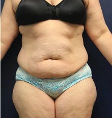 Tummy Tuck Before Photo by Laurence Glickman, MD, MSc, FRCS(c),  FACS; Garden City, NY - Case 38197