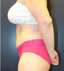 Tummy Tuck After Photo by Laurence Glickman, MD, MSc, FRCS(c),  FACS; Garden City, NY - Case 38197