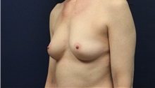 Breast Augmentation Before Photo by Laurence Glickman, MD, MSc, FRCS(c),  FACS; Garden City, NY - Case 38199