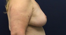 Breast Reduction After Photo by Laurence Glickman, MD, MSc, FRCS(c),  FACS; Garden City, NY - Case 38200
