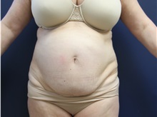 Tummy Tuck Before Photo by Laurence Glickman, MD, MSc, FRCS(c),  FACS; Garden City, NY - Case 38201