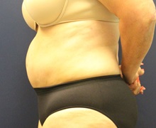 Tummy Tuck After Photo by Laurence Glickman, MD, MSc, FRCS(c),  FACS; Garden City, NY - Case 38201