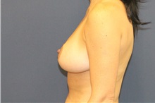 Breast Lift After Photo by Laurence Glickman, MD, MSc, FRCS(c),  FACS; Garden City, NY - Case 38204