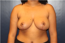 Breast Reduction After Photo by Laurence Glickman, MD, MSc, FRCS(c),  FACS; Garden City, NY - Case 38205