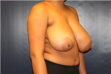 Breast Reduction Before Photo by Laurence Glickman, MD, MSc, FRCS(c),  FACS; Garden City, NY - Case 38205