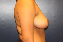 Breast Reduction After Photo by Laurence Glickman, MD, MSc, FRCS(c),  FACS; Garden City, NY - Case 38205