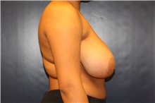 Breast Reduction Before Photo by Laurence Glickman, MD, MSc, FRCS(c),  FACS; Garden City, NY - Case 38205