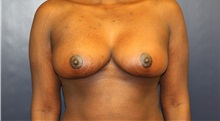 Breast Lift After Photo by Laurence Glickman, MD, MSc, FRCS(c),  FACS; Garden City, NY - Case 38206