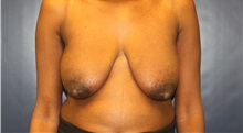 Breast Lift Before Photo by Laurence Glickman, MD, MSc, FRCS(c),  FACS; Garden City, NY - Case 38206