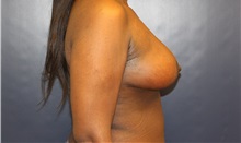 Breast Lift After Photo by Laurence Glickman, MD, MSc, FRCS(c),  FACS; Garden City, NY - Case 38206