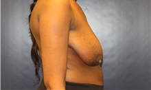 Breast Lift Before Photo by Laurence Glickman, MD, MSc, FRCS(c),  FACS; Garden City, NY - Case 38206
