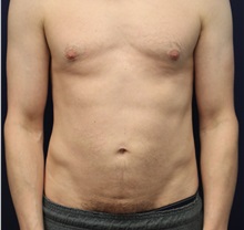 Liposuction After Photo by Laurence Glickman, MD, MSc, FRCS(c),  FACS; Garden City, NY - Case 38207