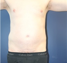 Liposuction Before Photo by Laurence Glickman, MD, MSc, FRCS(c),  FACS; Garden City, NY - Case 38207