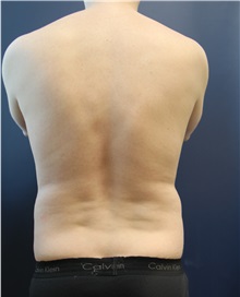 Liposuction Before Photo by Laurence Glickman, MD, MSc, FRCS(c),  FACS; Garden City, NY - Case 38208