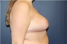 Breast Reduction After Photo by Laurence Glickman, MD, MSc, FRCS(c),  FACS; Garden City, NY - Case 38209