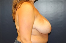 Breast Reduction Before Photo by Laurence Glickman, MD, MSc, FRCS(c),  FACS; Garden City, NY - Case 38209