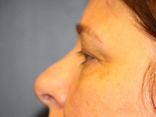 Eyelid Surgery Before Photo by Laurence Glickman, MD, MSc, FRCS(c),  FACS; Garden City, NY - Case 38211