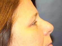 Eyelid Surgery After Photo by Laurence Glickman, MD, MSc, FRCS(c),  FACS; Garden City, NY - Case 38211