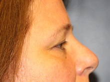 Eyelid Surgery Before Photo by Laurence Glickman, MD, MSc, FRCS(c),  FACS; Garden City, NY - Case 38211