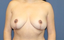 Breast Reduction After Photo by Laurence Glickman, MD, MSc, FRCS(c),  FACS; Garden City, NY - Case 38213