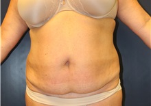Tummy Tuck Before Photo by Laurence Glickman, MD, MSc, FRCS(c),  FACS; Garden City, NY - Case 38214