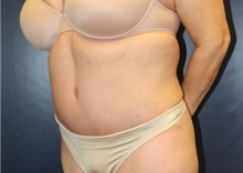 Tummy Tuck After Photo by Laurence Glickman, MD, MSc, FRCS(c),  FACS; Garden City, NY - Case 38214
