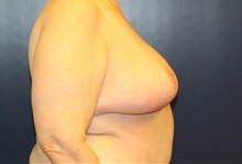 Breast Reduction After Photo by Laurence Glickman, MD, MSc, FRCS(c),  FACS; Garden City, NY - Case 38215