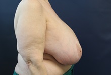 Breast Reduction Before Photo by Laurence Glickman, MD, MSc, FRCS(c),  FACS; Garden City, NY - Case 38215