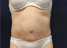 Tummy Tuck After Photo by Laurence Glickman, MD, MSc, FRCS(c),  FACS; Garden City, NY - Case 38217