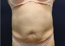 Tummy Tuck Before Photo by Laurence Glickman, MD, MSc, FRCS(c),  FACS; Garden City, NY - Case 38217