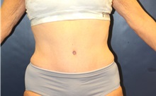 Tummy Tuck After Photo by Laurence Glickman, MD, MSc, FRCS(c),  FACS; Garden City, NY - Case 38219