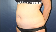Tummy Tuck Before Photo by Laurence Glickman, MD, MSc, FRCS(c),  FACS; Garden City, NY - Case 38219