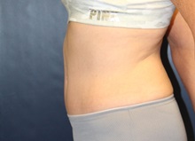 Tummy Tuck After Photo by Laurence Glickman, MD, MSc, FRCS(c),  FACS; Garden City, NY - Case 38219