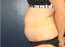 Tummy Tuck Before Photo by Laurence Glickman, MD, MSc, FRCS(c),  FACS; Garden City, NY - Case 38219