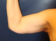 Arm Lift After Photo by Laurence Glickman, MD, MSc, FRCS(c),  FACS; Garden City, NY - Case 38220
