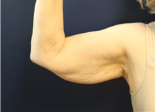 Arm Lift Before Photo by Laurence Glickman, MD, MSc, FRCS(c),  FACS; Garden City, NY - Case 38220