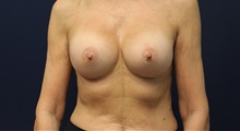 Breast Augmentation After Photo by Laurence Glickman, MD, MSc, FRCS(c),  FACS; Garden City, NY - Case 38221
