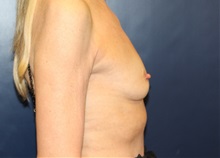 Breast Augmentation Before Photo by Laurence Glickman, MD, MSc, FRCS(c),  FACS; Garden City, NY - Case 38221
